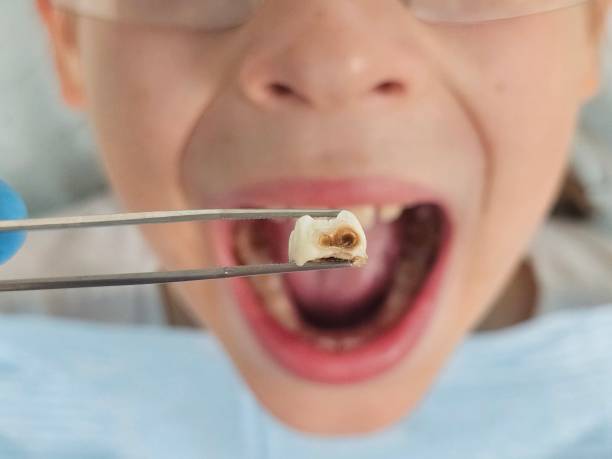 Best Emergency Dentist for Lost Fillings or Crowns in Manning, SC